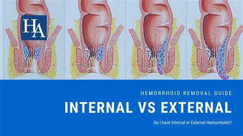 internal vs external hemorrhoids pictures.